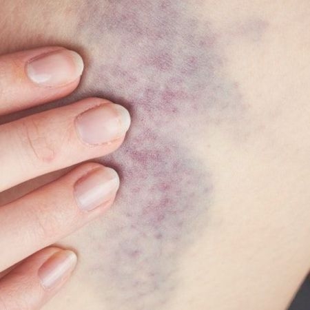 صورة للفئة الكدمات والتورمات